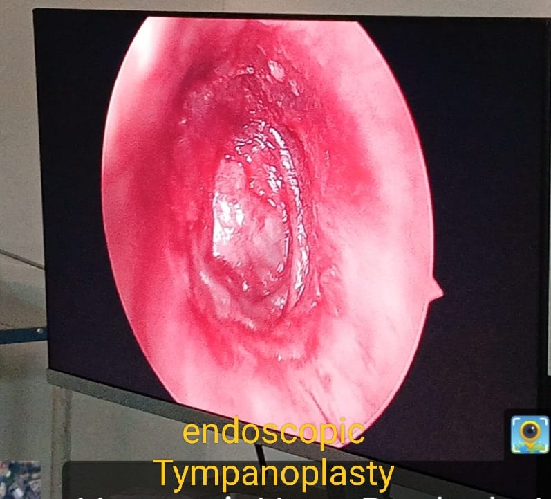 Endoscopic tympanoplasty — intraoperative view