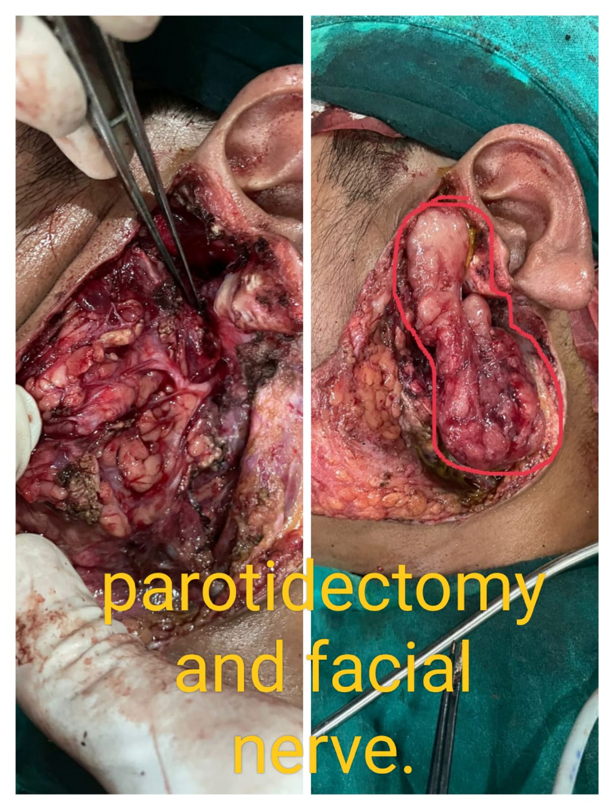 Head and neck surgical case at Satkriti Hospital