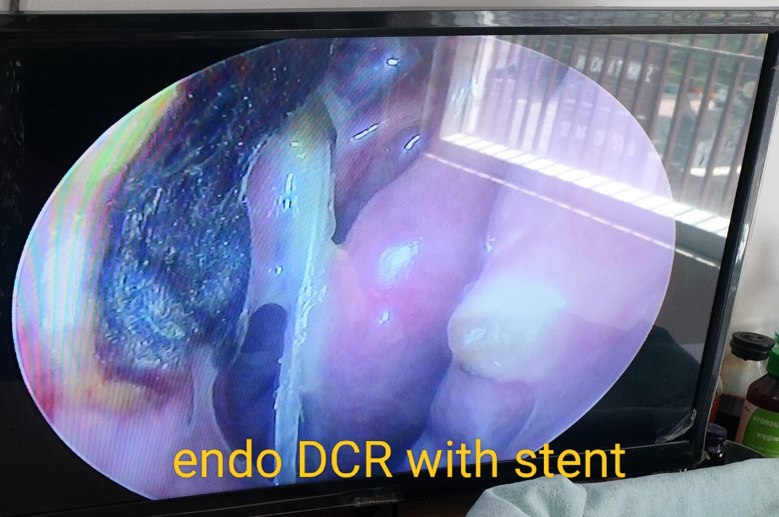 Endoscopic DCR with stent