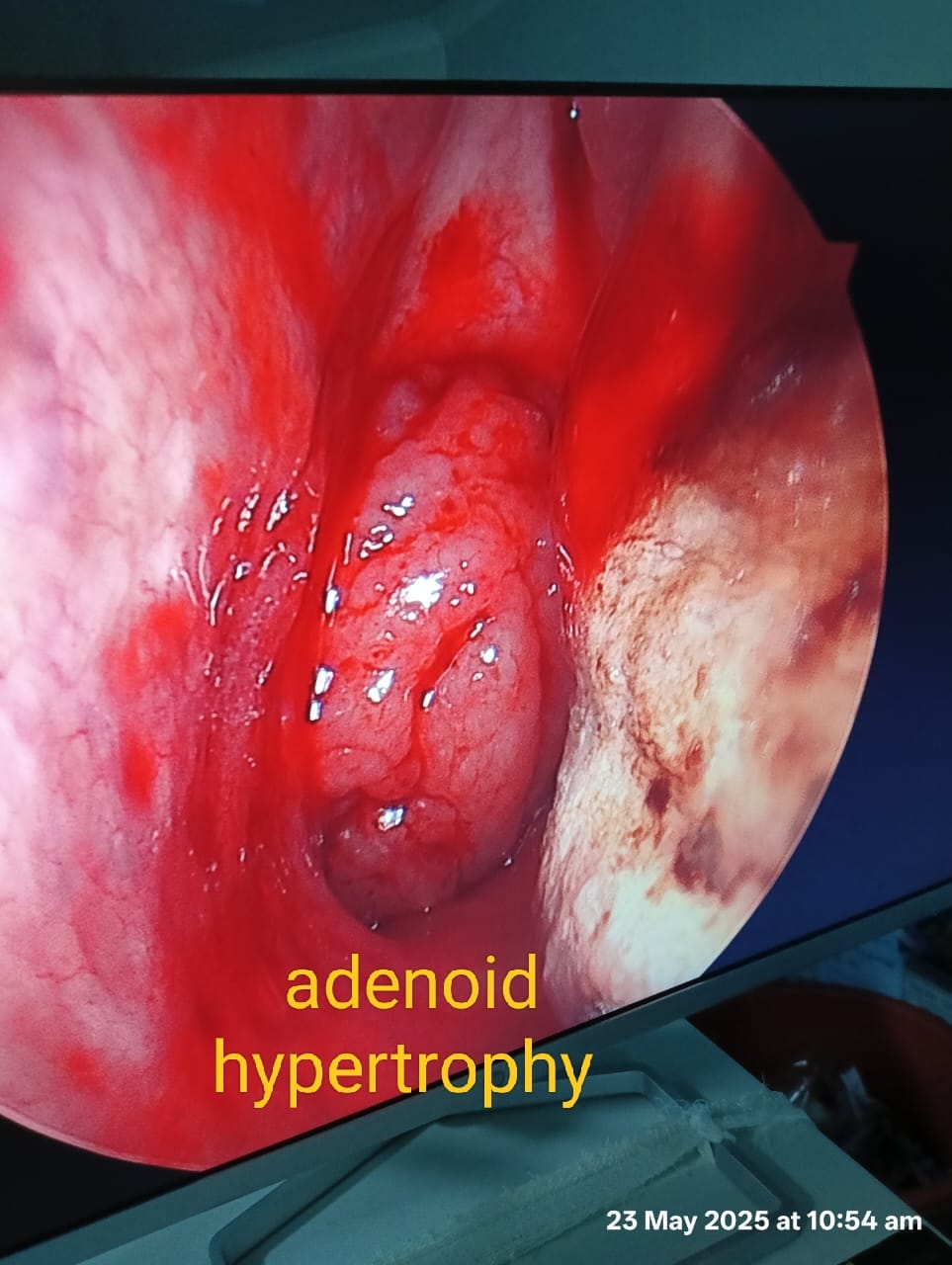 Adenoid hypertrophy seen on endoscopy