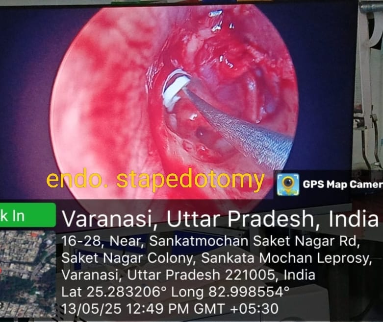 Endoscopic stapedotomy — intraoperative view