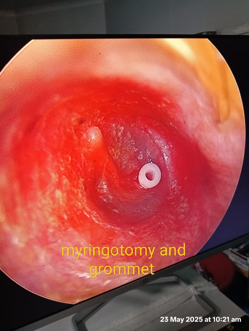 Myringotomy and grommet insertion — endoscopic view