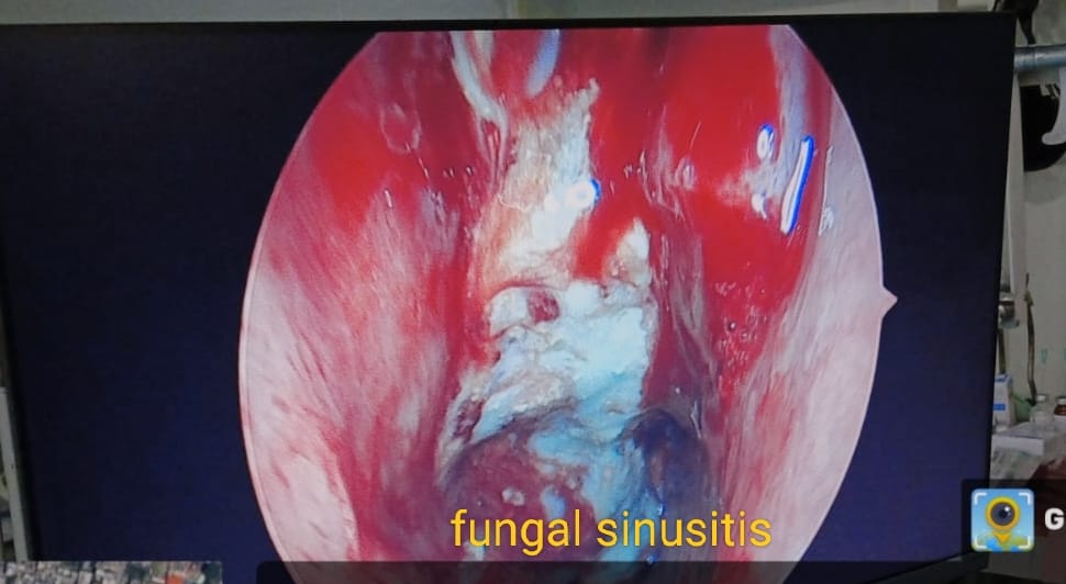 Fungal sinusitis seen on endoscopy