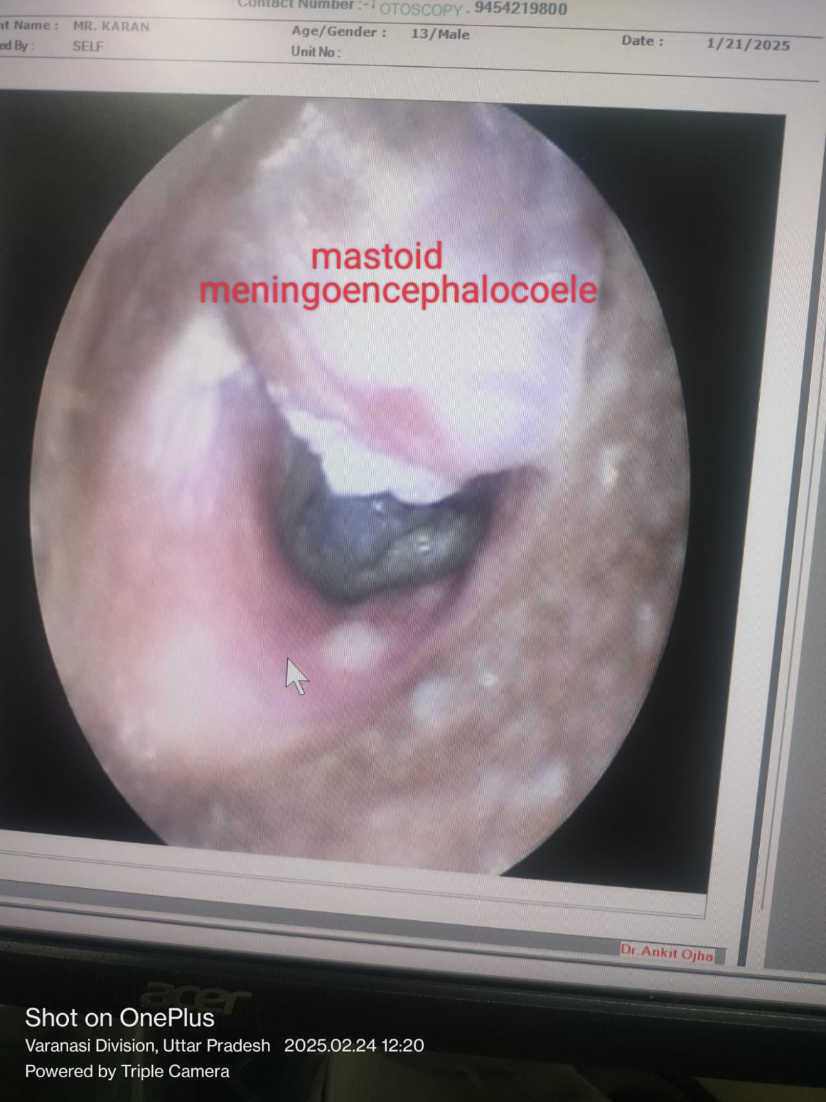 Mastoid meningoencephalocoele — imaging view
