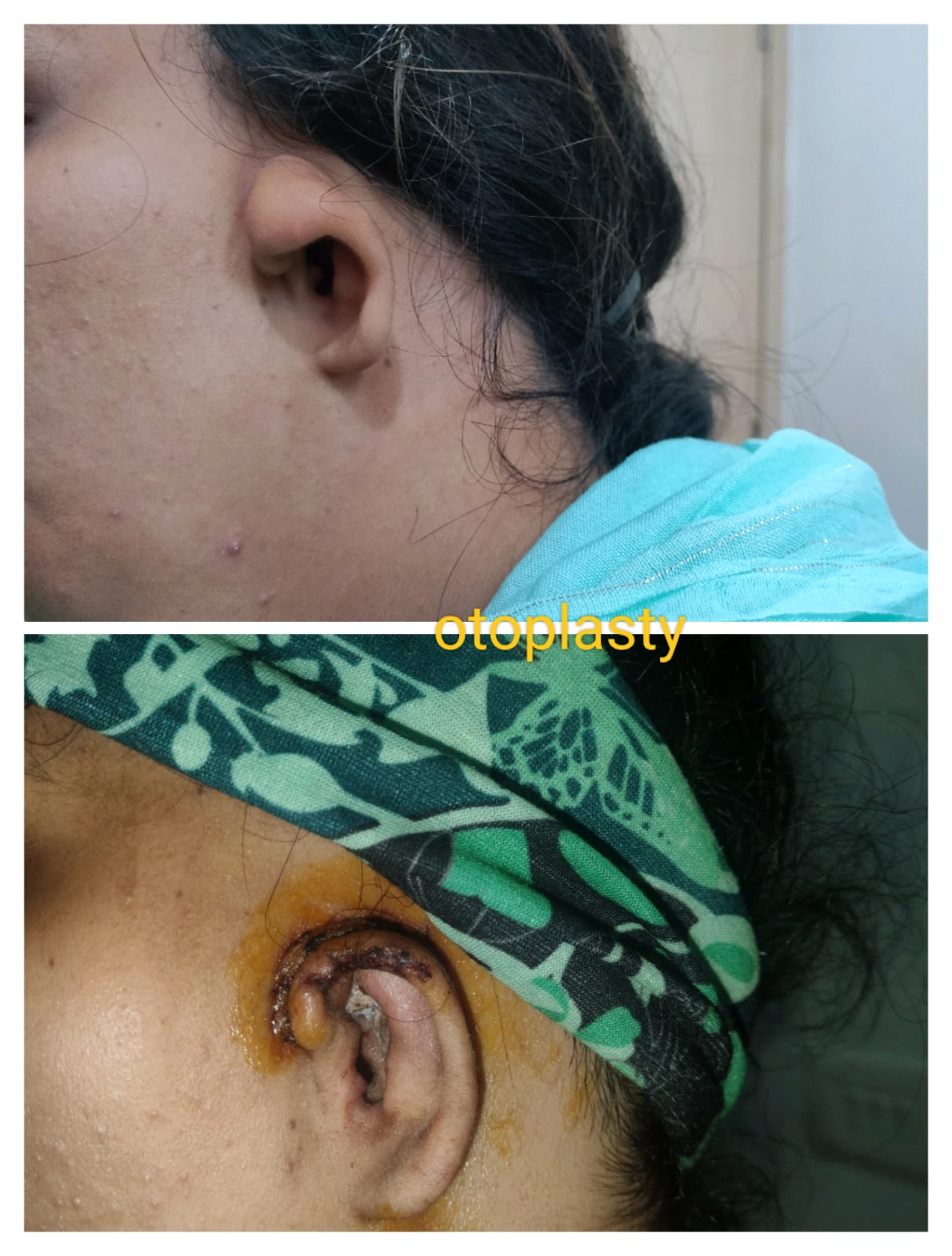 Otoplasty — before and after