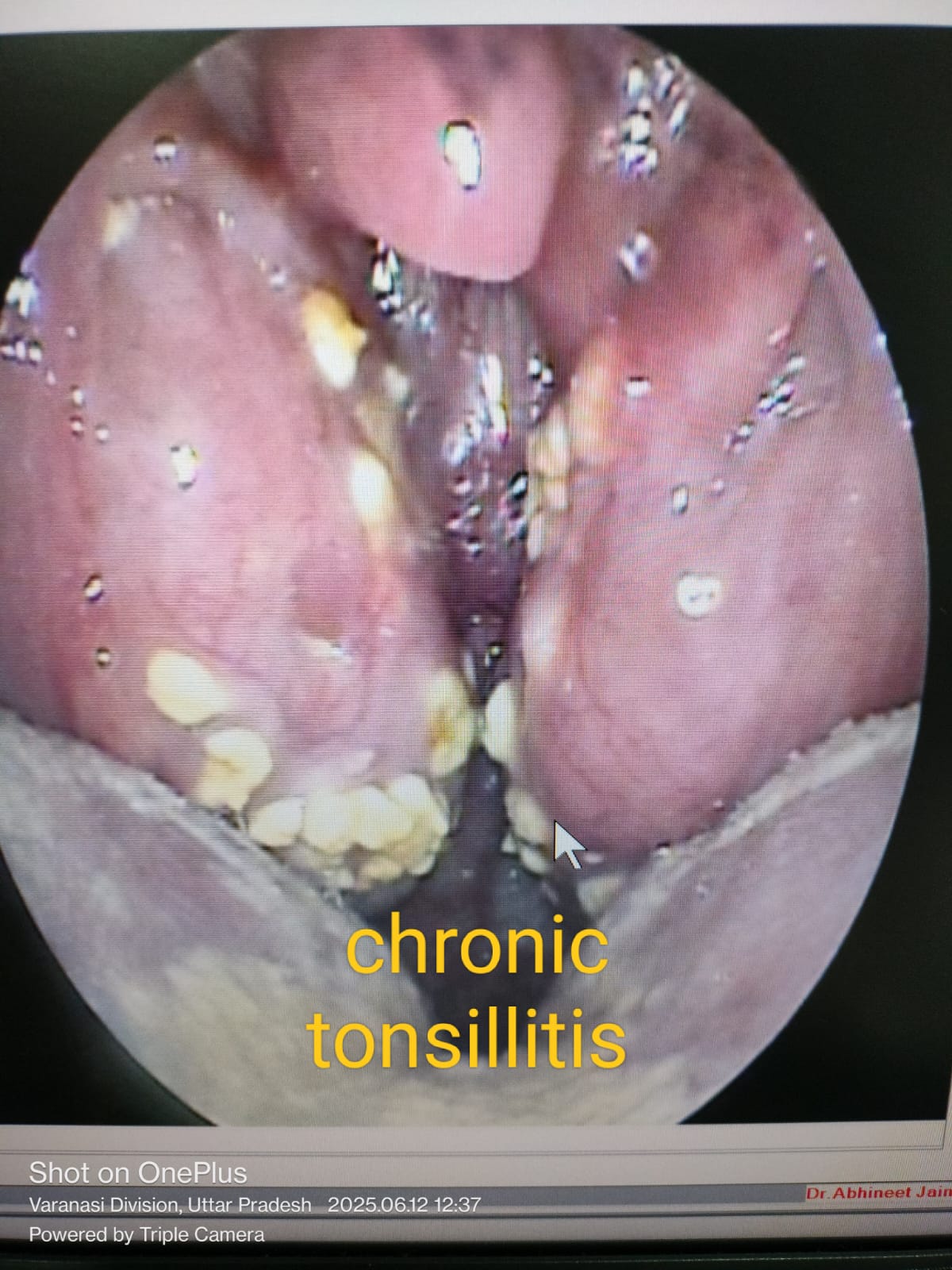 Chronic tonsillitis seen on endoscopy