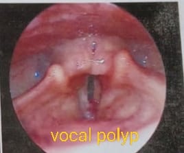 Microlaryngeal voice surgery — endoscopic view