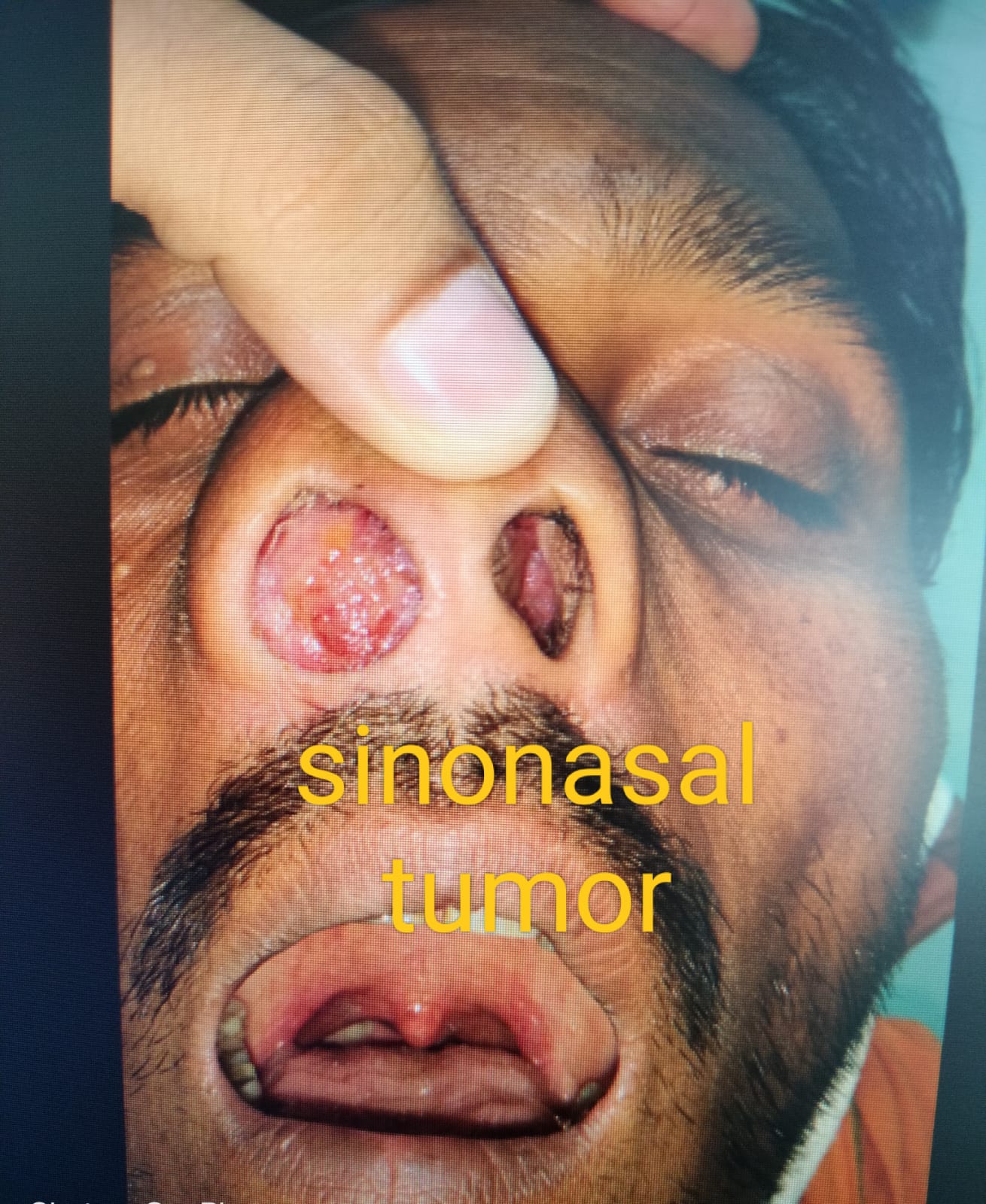 Sinonasal tumour case